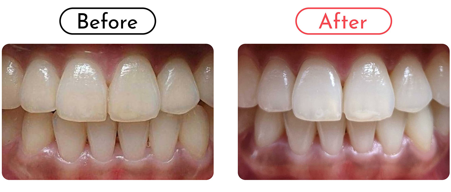 ホワイトニング